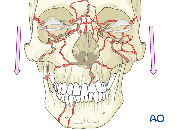 Panfacial fractures (sequencing of repair) - Principles