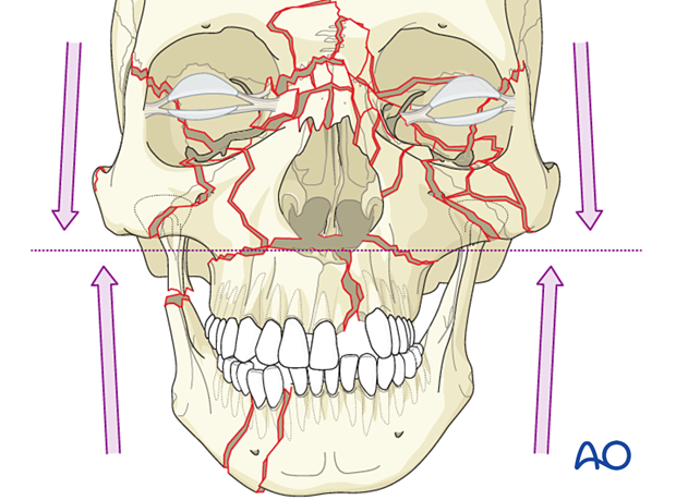 Panfacial fractures (sequencing of repair) - Principles