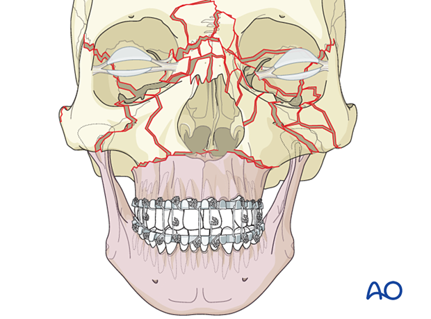 Panfacial fractures (sequencing of repair) - Principles