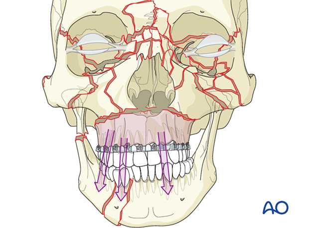 Panfacial fractures (sequencing of repair) - Principles