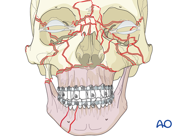 Panfacial fractures (sequencing of repair) - Principles