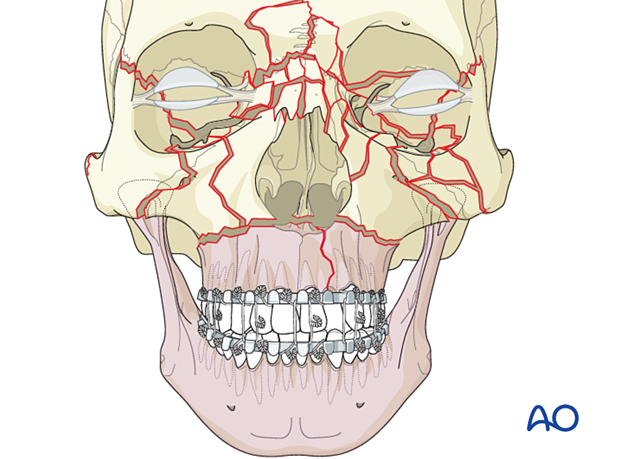 Panfacial fractures (sequencing of repair) - Principles