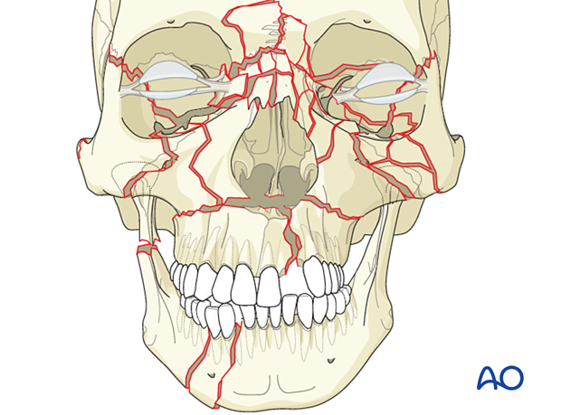 Panfacial fractures (sequencing of repair) - Principles