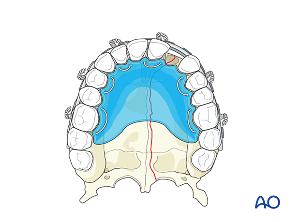 Panfacial fractures (sequencing of repair) - Principles