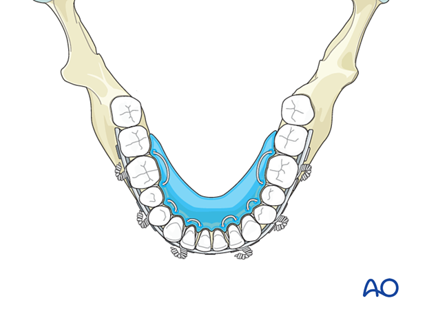 Panfacial fractures (sequencing of repair) - Principles