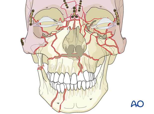 Panfacial fractures (sequencing of repair) - Sequencing from the calvarium down