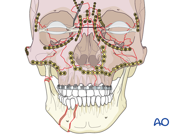Panfacial fractures (sequencing of repair) - Sequencing from the calvarium down