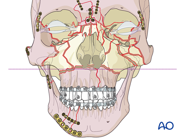 Panfacial fractures (sequencing of repair) - Divide the face into upper and lower halves and stabilize them at the Le Fort I level