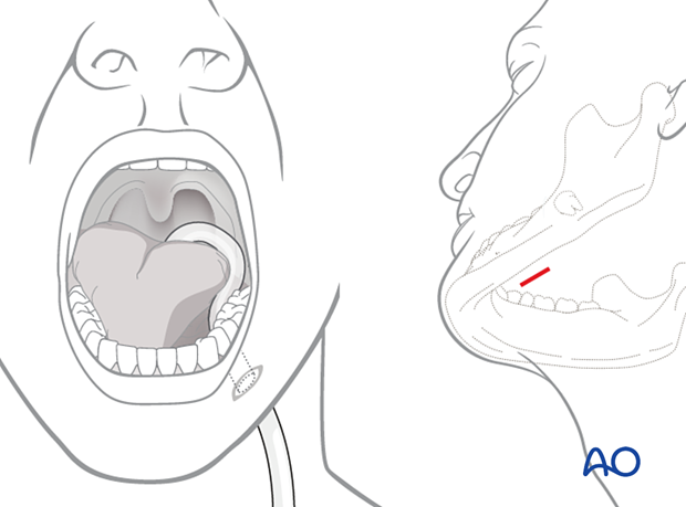 Airway considerations