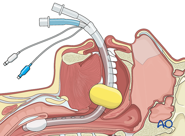 Airway considerations