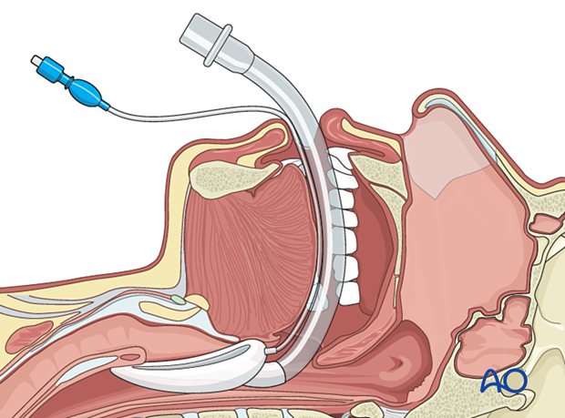 92 X130 Airway considerations