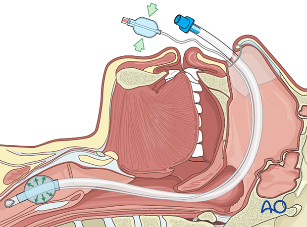 Airway considerations