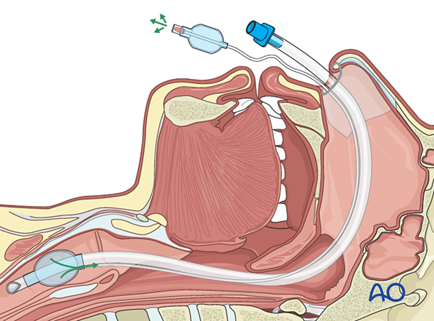 Airway considerations