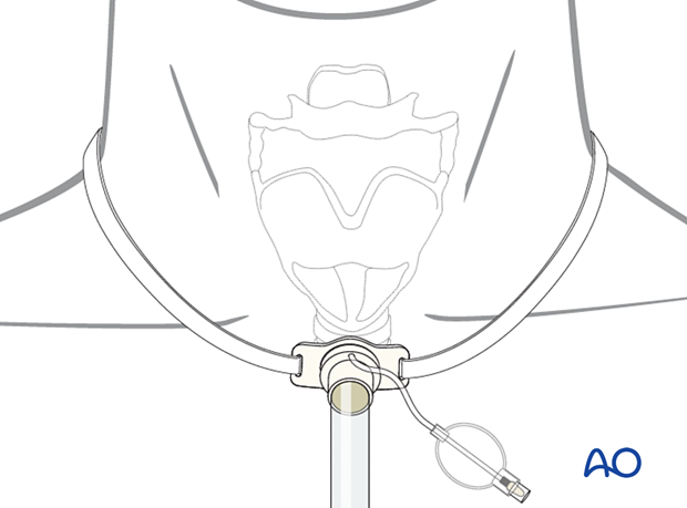 Airway considerations