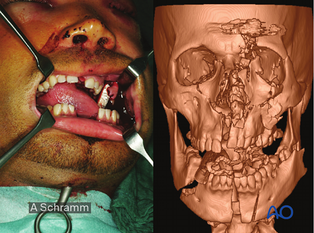 computer assisted surgery gunshot virtual planning and intraoperative navigation - clinical picture and 3D CT scan 