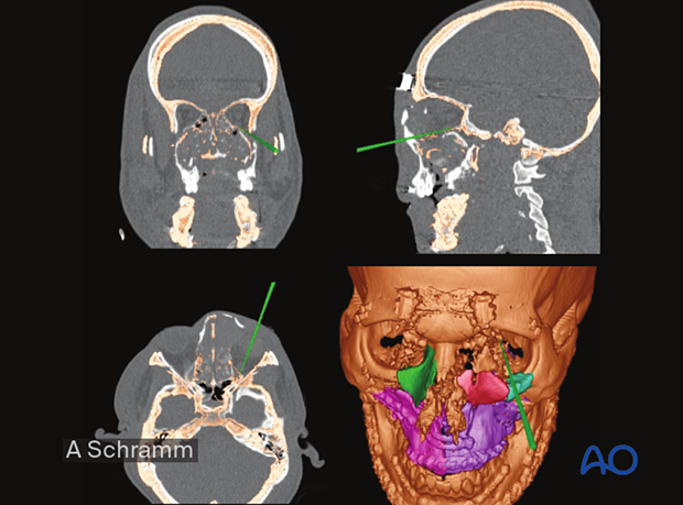 computer assisted surgery gunshot virtual planning and intraoperative navigation gunshot - virtual reduction and reconstruction