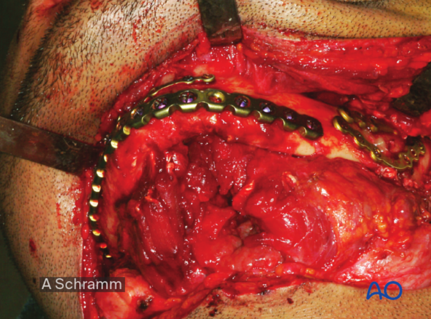 computer assisted surgery gunshot virtual planning, and intraoperative navigation gunshot - mandibular reconstruction