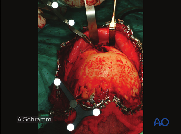 computer assisted surgery gunshot virtual planning, and intraoperative navigation gunshot - midface and skull reconstruction using intraoperative navigation