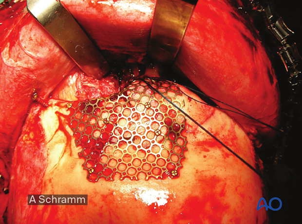 computer assisted surgery gunshot virtual planning and intraoperative navigation gunshot - midface and skull reconstruction using intraoperative navigation
