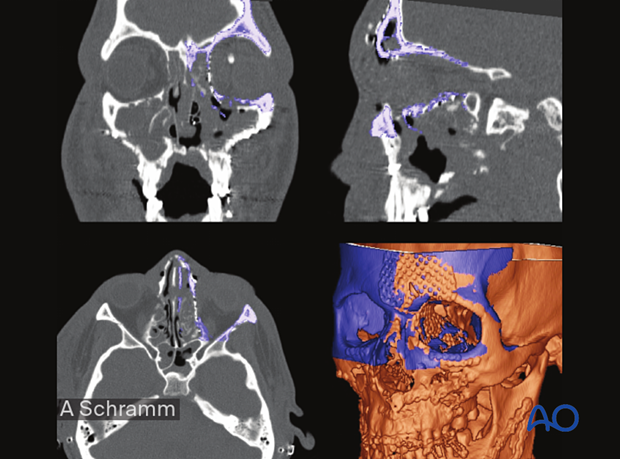 computer assisted surgery gunshot virtual planning, and intraoperative navigation gunshot - postoperative control