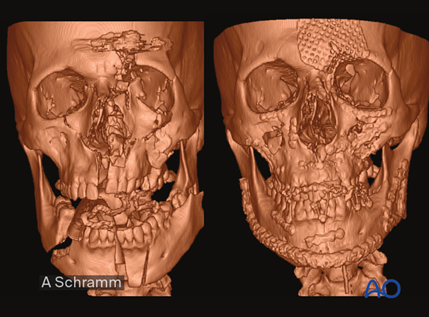 computer assisted surgery gunshot virtual planning, and intraoperative navigation gunshot - postoperative control