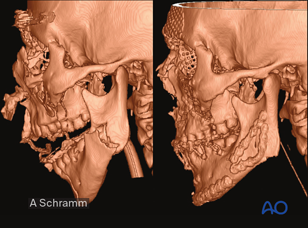 computer assisted surgery gunshot virtual planning and intraoperative navigation gunshot - postoperative control