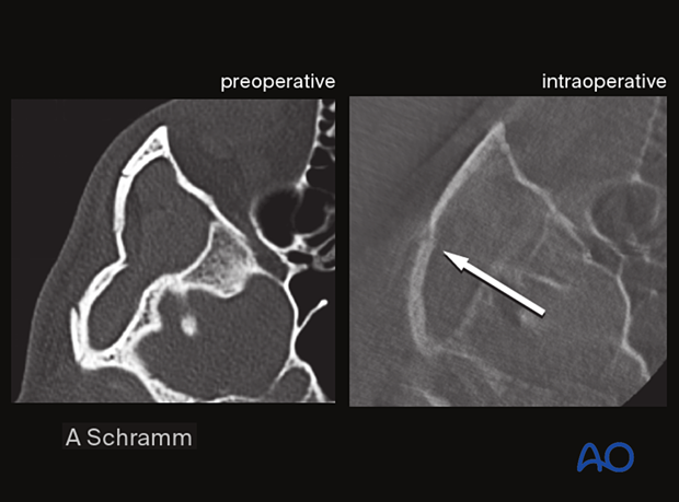 computer assisted surgery zygomatic arch intraoperative imaging closed reduction