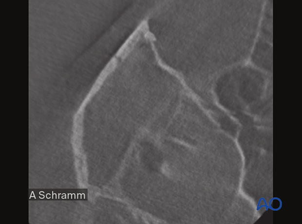 computer assisted surgery zygomatic arch intraoperative imaging closed reduction