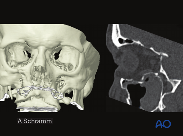 cas virtual planning and intraoperative imaging orif without orbital reconstruction – preoperative imaging