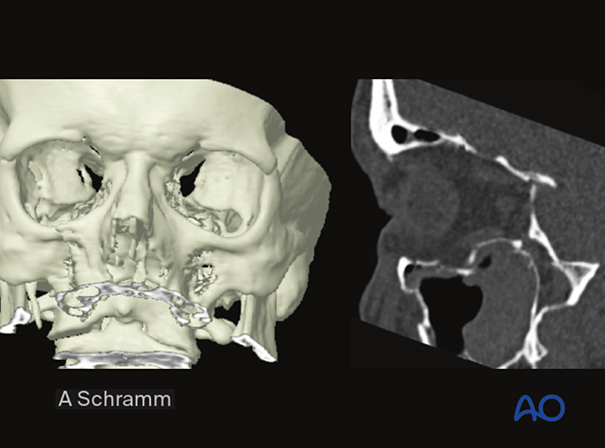 CAS: virtual planning and intraoperative imaging (ORIF without orbital ...