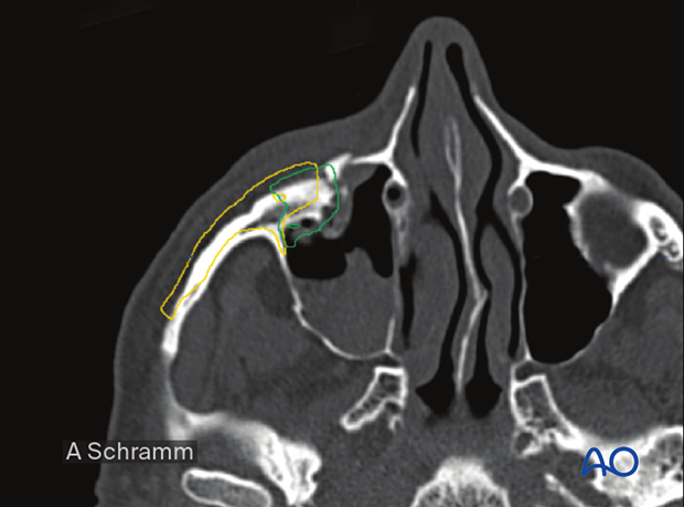 cas virtual planning and intraoperative imaging orif without orbital reconstruction – virtual reduction