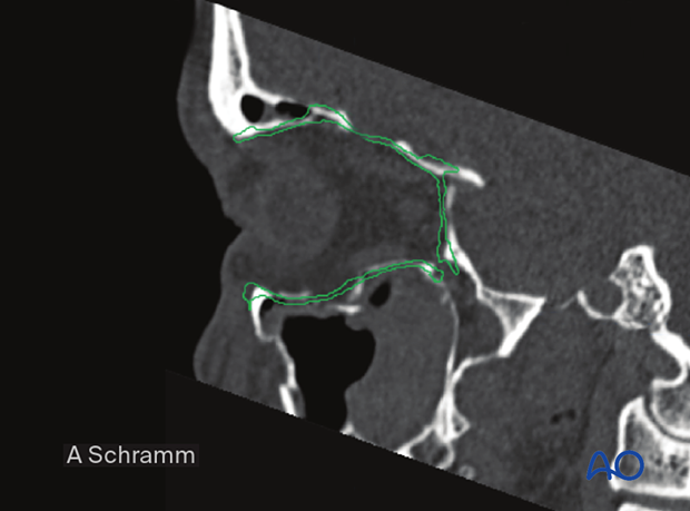 cas virtual planning and intraoperative imaging orif without orbital reconstruction – virtual reduction