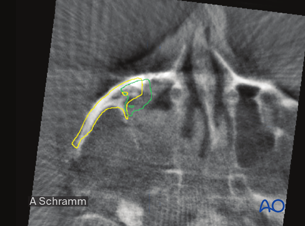 computer assisted surgery gunshot injury virtual planning and intraoperative navigation - Intraoperative assessment of reduction