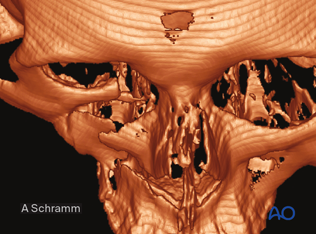 CAS: virtual planning and intraoperative imaging (ORIF with orbital reconstruction) – preoperative imaging