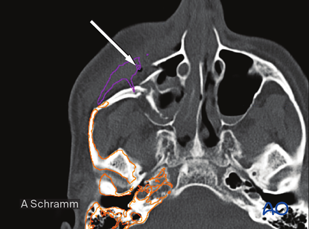 CAS: virtual planning and intraoperative imaging (ORIF with orbital reconstruction) – virtual zygoma reduction