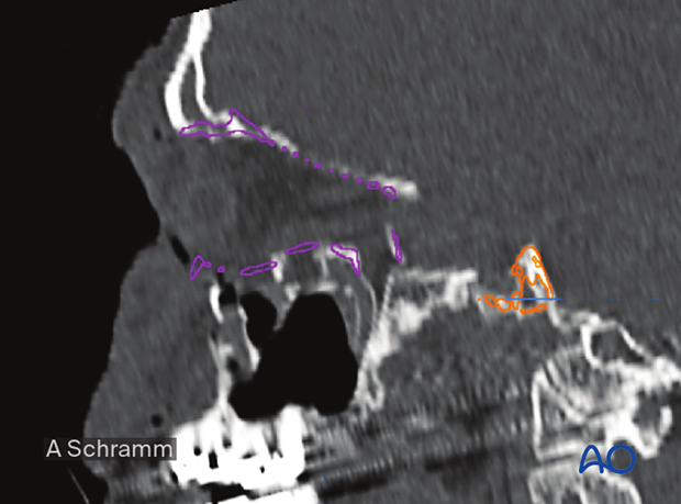 CAS: virtual planning and intraoperative imaging (ORIF with orbital reconstruction) – virtual orbital wall reconstruction