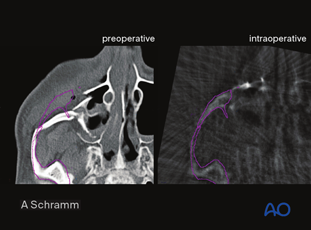cas virtual planning and intraoperative imaging orif with orbital reconstruction