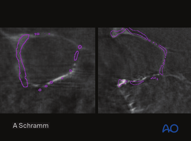 cas virtual planning and intraoperative imaging orif with orbital reconstruction