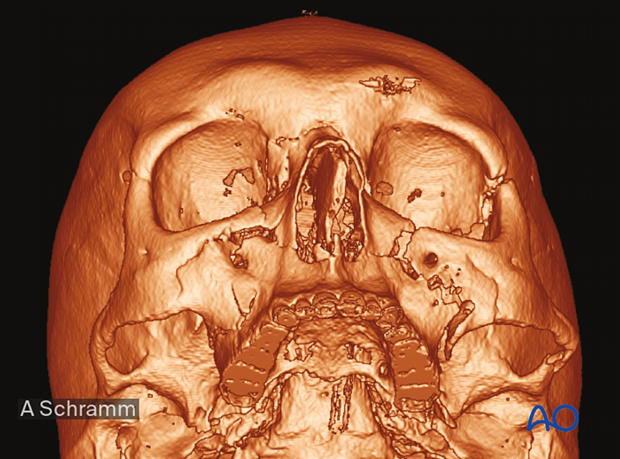 CAS: virtual planning and intraoperative navigation (ORIF with orbital reconstruction) -  virtual planning