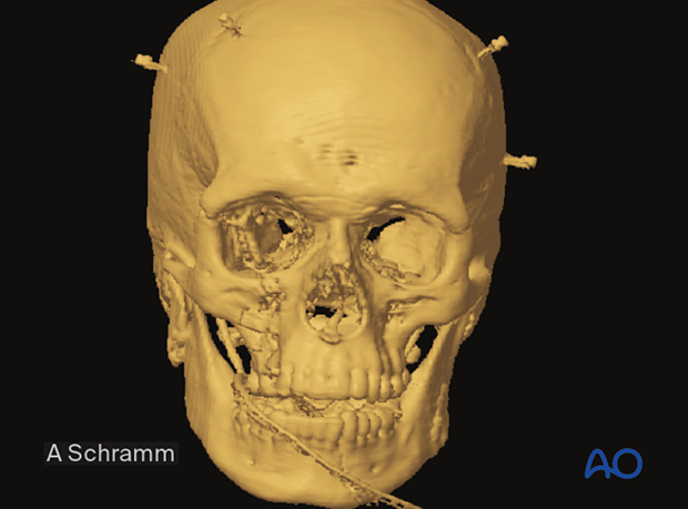 CAS: virtual planning and intraoperative navigation (ORIF with orbital reconstruction) -  virtual planning