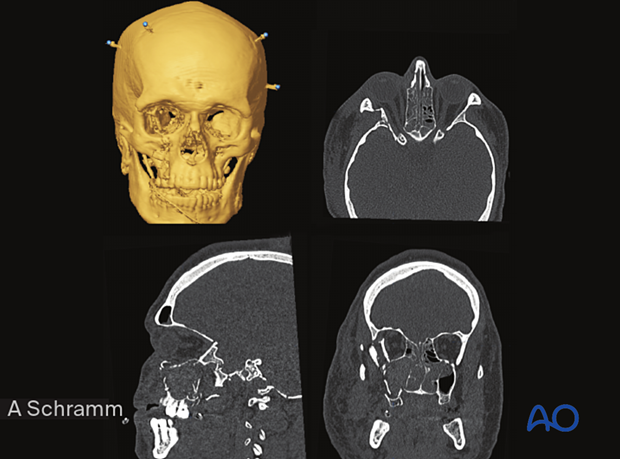 CAS: virtual planning and intraoperative navigation (ORIF with orbital reconstruction) -  orientation of the data sets