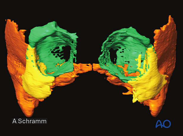 CAS: virtual planning and intraoperative navigation (ORIF with orbital reconstruction) -  segmentation