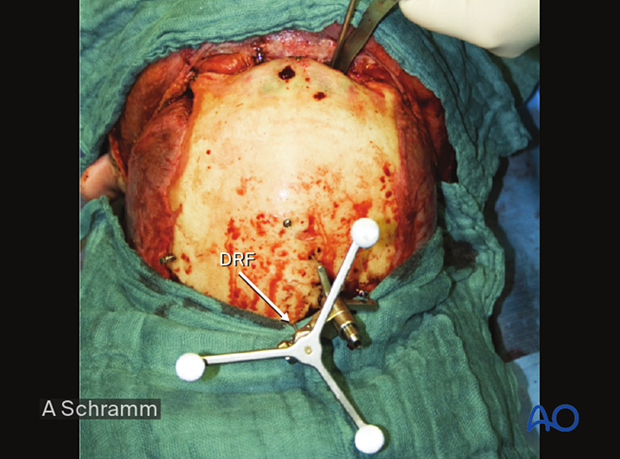 CAS: virtual planning and intraoperative navigation (ORIF with orbital reconstruction) - zygoma reduction using intraoperative navigation