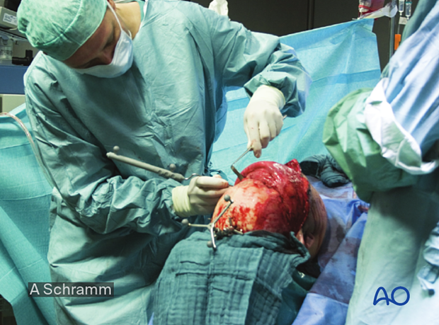 CAS: virtual planning and intraoperative navigation (ORIF with orbital reconstruction) - zygoma reduction using intraoperative navigation