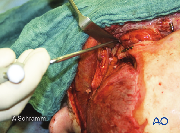 CAS: virtual planning and intraoperative navigation (ORIF with orbital reconstruction) - zygoma reduction using intraoperative navigation