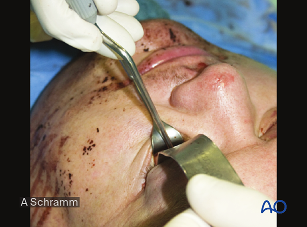 cas virtual planning and intraoperative navigation orif with orbital reconstruction - virtual reduction and reconstruction - orbital wall reconstruction using intraoperative navigation