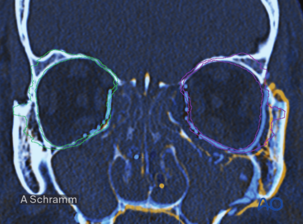 cas virtual planning and intraoperative navigation orif with orbital reconstruction - intraoperative or postoperative assessment of reconstruction/reduction