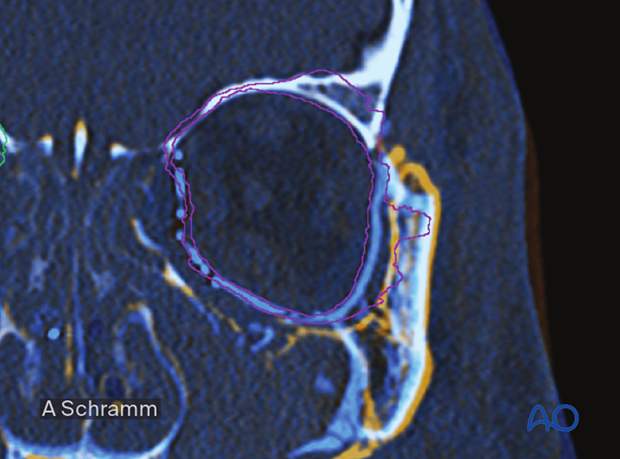 cas virtual planning and intraoperative navigation orif with orbital reconstruction - intraoperative or postoperative assessment of reconstruction/reduction