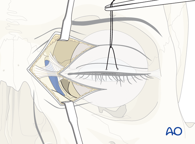 Extended glabellar approach