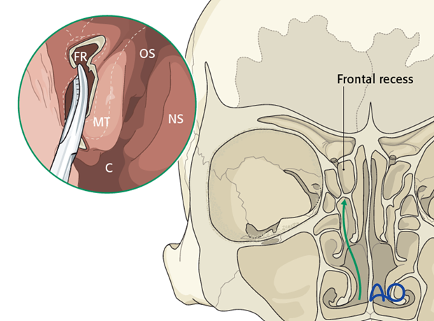 Endoscopic transnasal approach to the frontal sinus